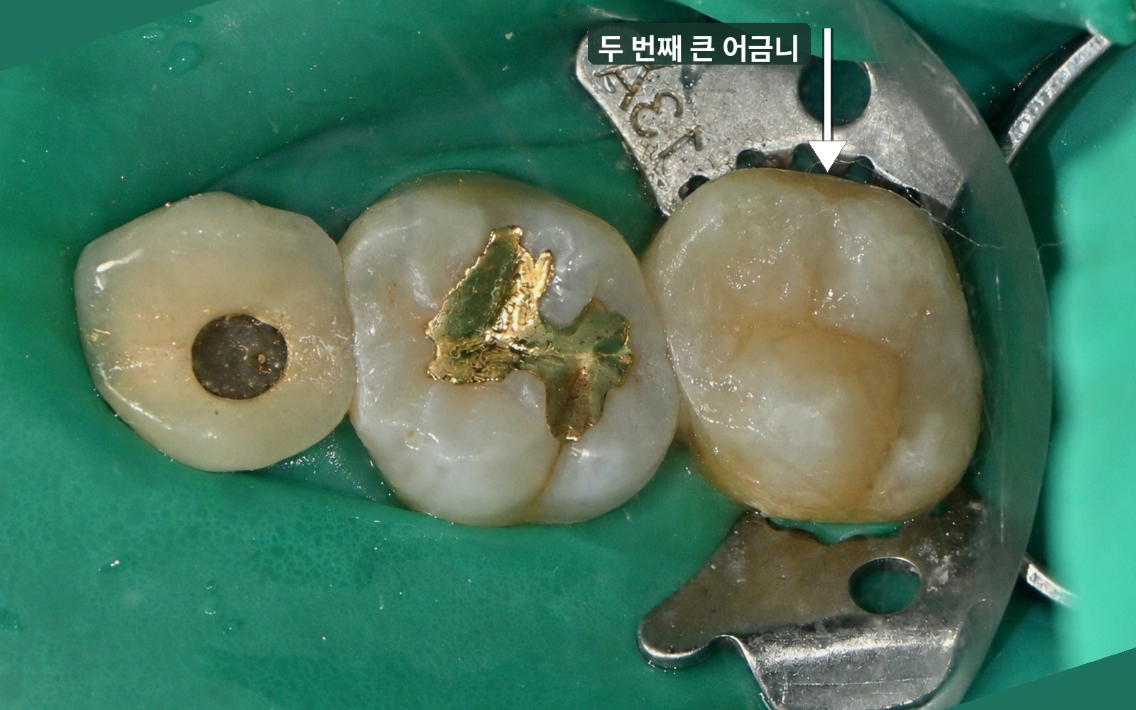 치료 후: 금 인레이를 제거한 두 번째 큰 어금니가 치아색 레진으로 원래 치아 모양대로 회복됨