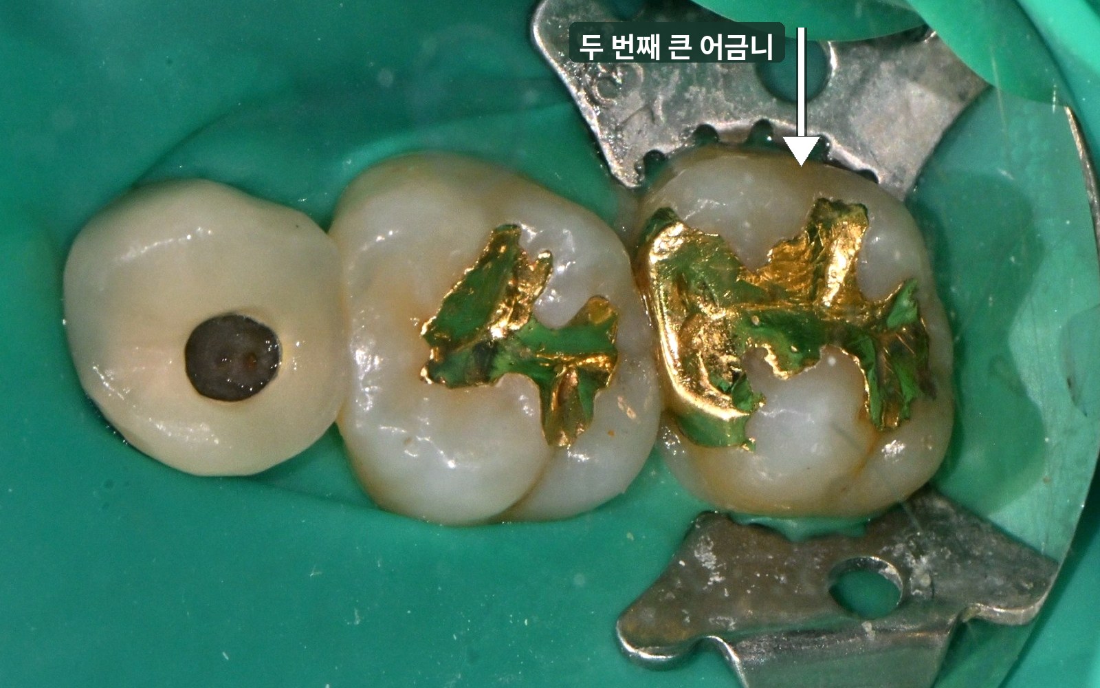 치료 전: 화살표로 표시한 두 번째 큰 어금니에 넓은 금 인레이가 들어 있음