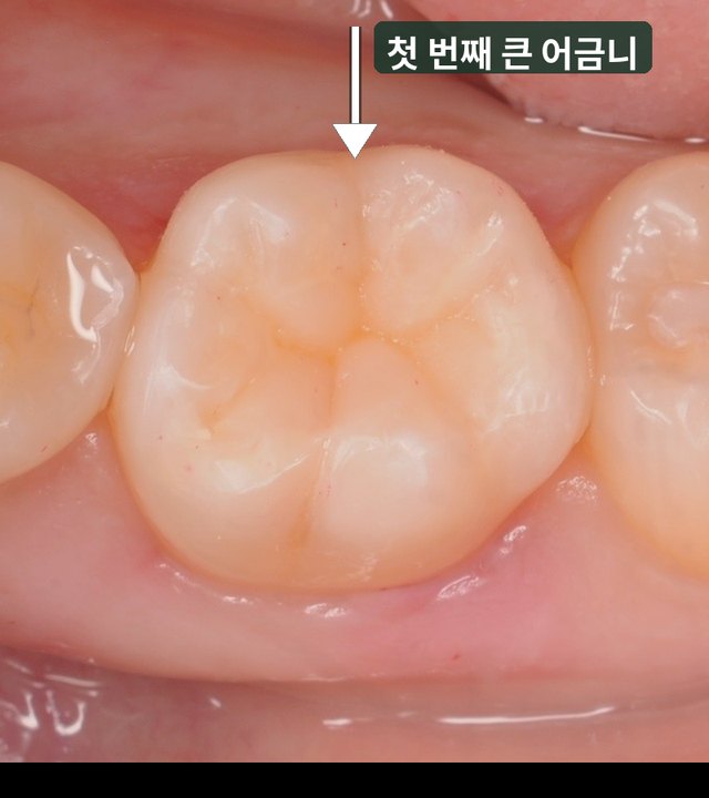치료 후 첫 번째 큰 어금니