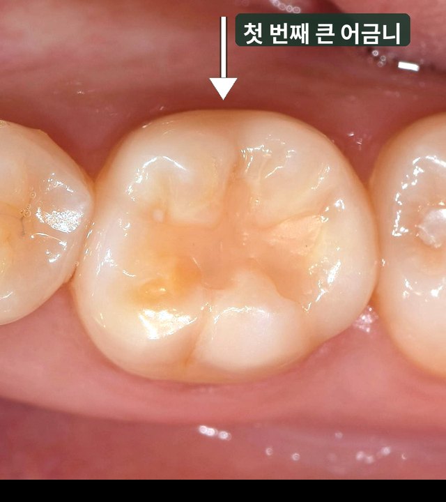 치료 전 첫 번째 큰 어금니